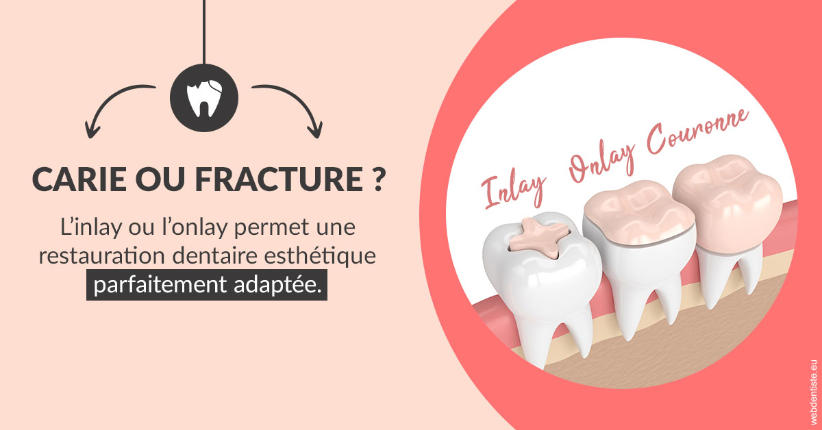 https://www.drs-bourhis-et-lawniczak-orthodontistes.fr/T2 2023 - Carie ou fracture 2