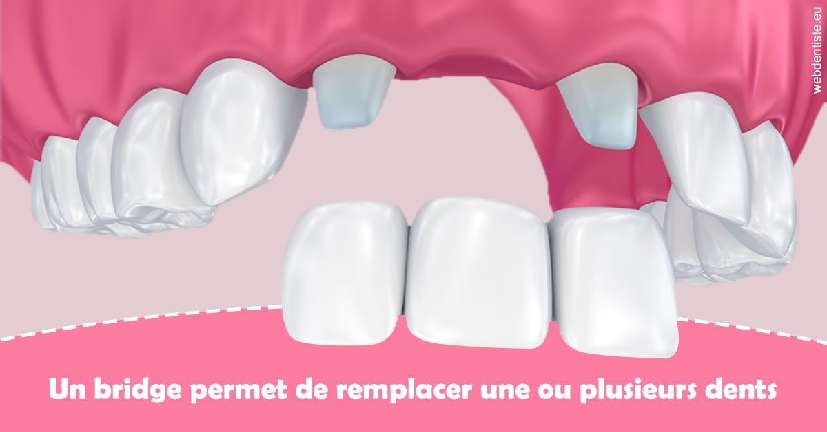 https://www.drs-bourhis-et-lawniczak-orthodontistes.fr/Bridge remplacer dents 2