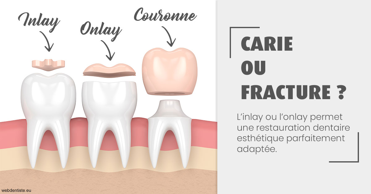 https://www.drs-bourhis-et-lawniczak-orthodontistes.fr/T2 2023 - Carie ou fracture 1