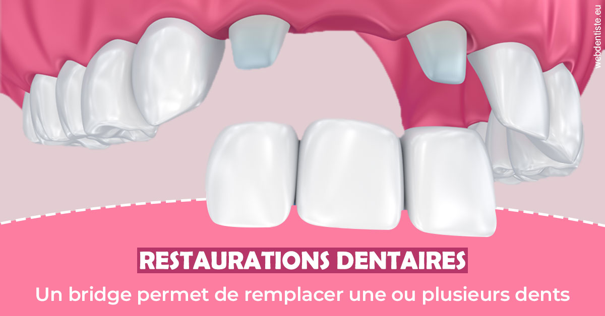 https://www.drs-bourhis-et-lawniczak-orthodontistes.fr/Bridge remplacer dents 2