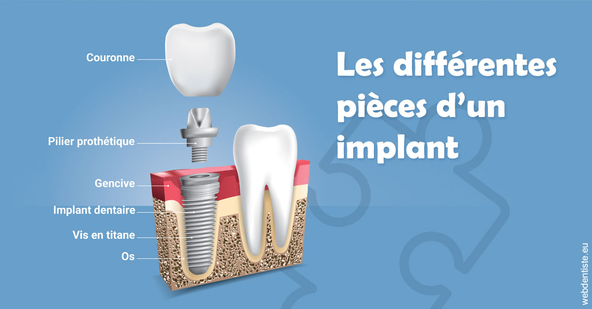 https://www.drs-bourhis-et-lawniczak-orthodontistes.fr/Les différentes pièces d’un implant 1